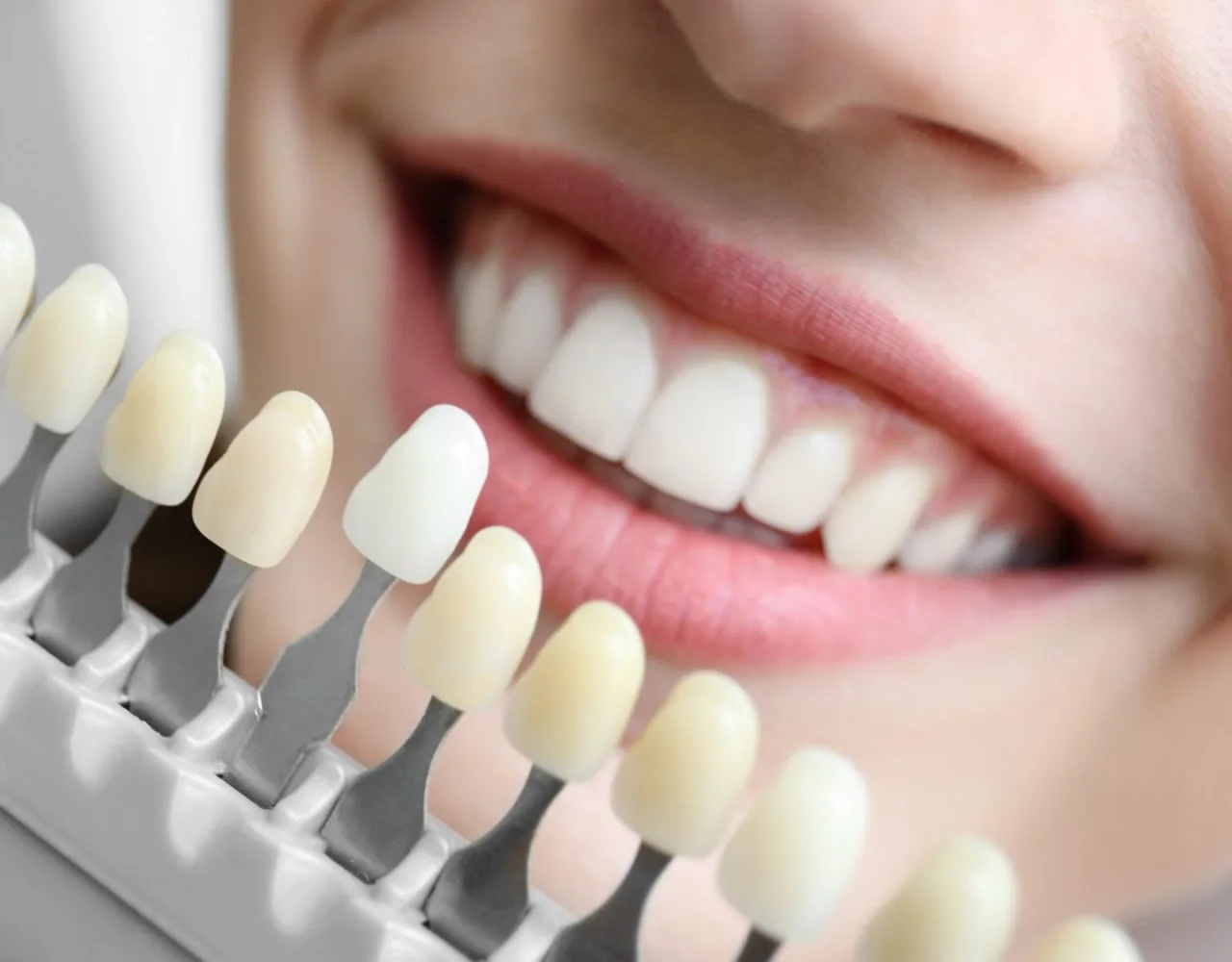 Guia de tonalidades de facetas ao lado de sorriso natural — Odontologia Estética Migliore
